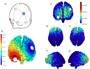 Tea Y Neuromodulaci N Tdcs Instituto Neurocognitivo Incia