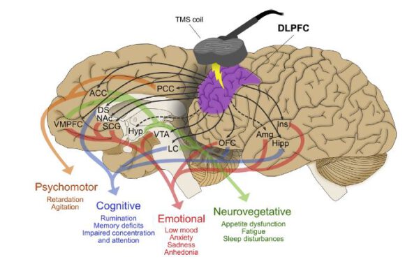 Emt Neuromodulación Instituto Neurocognitivo Incia