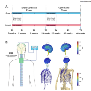 La estimulación transcraneal de corriente directa corticoespinal (tDCS) podría mitigar los síntomas en pacientes con ELA
